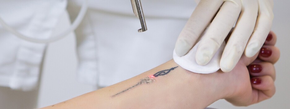 Стираем ошибки, или Как может помочь лазерное удаление тату (новости компаний)