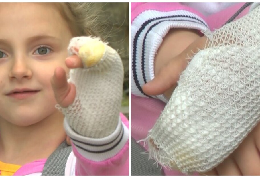 Девочку укусила змея в Энергодаре - ей сделали операцию, фото и подробности - фото 1