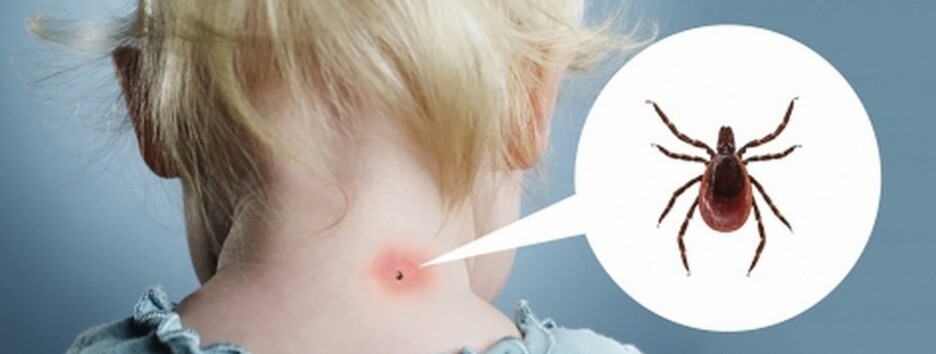 Укус кліща: поширені помилки, які не можна повторювати