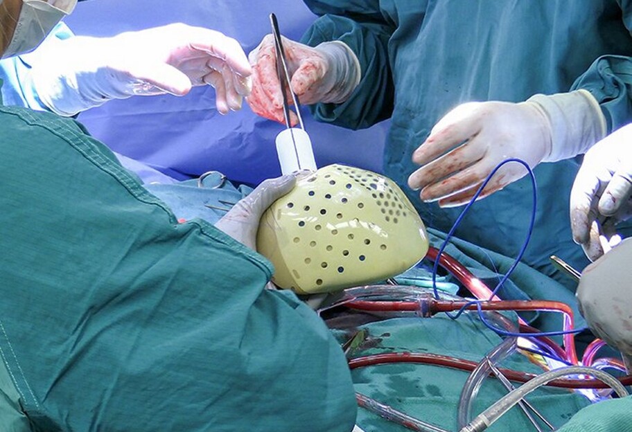 Пересадка серця - компанія Carmat вперше продала штучний орган - фото - фото 1