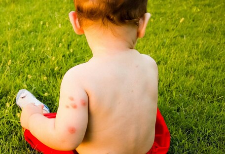 Доктор Комаровський розповів, як правильно захистити дітей від комарів