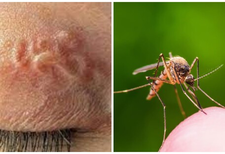 Черв'яки під шкірою: у Києві зафіксували рідкісне захворювання після укусу комара
