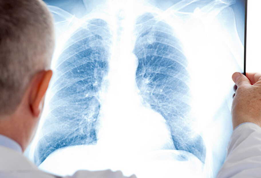 Рак легенів можна розпізнати за трьома основними симптомами – медик назвав їх  - фото 1