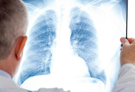 Є три симптоми: як вчасно розпізнати рак легенів