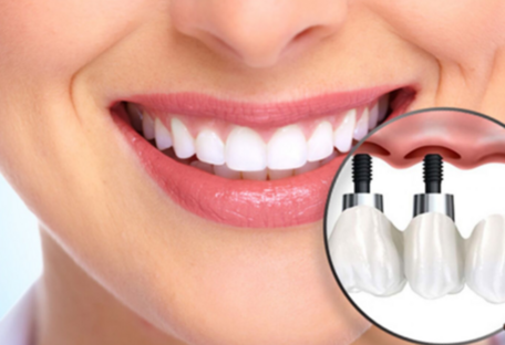 Імплантація чи протезування зубів: в чому різниця та що обрати