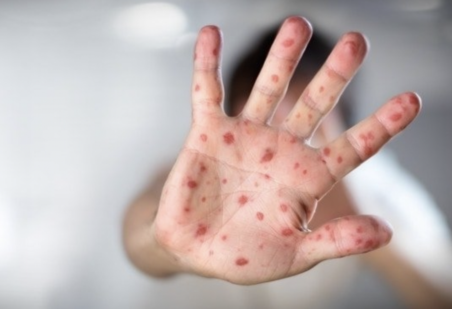 Корь в Украине 2025 - симптомы и профилактика - фото 1