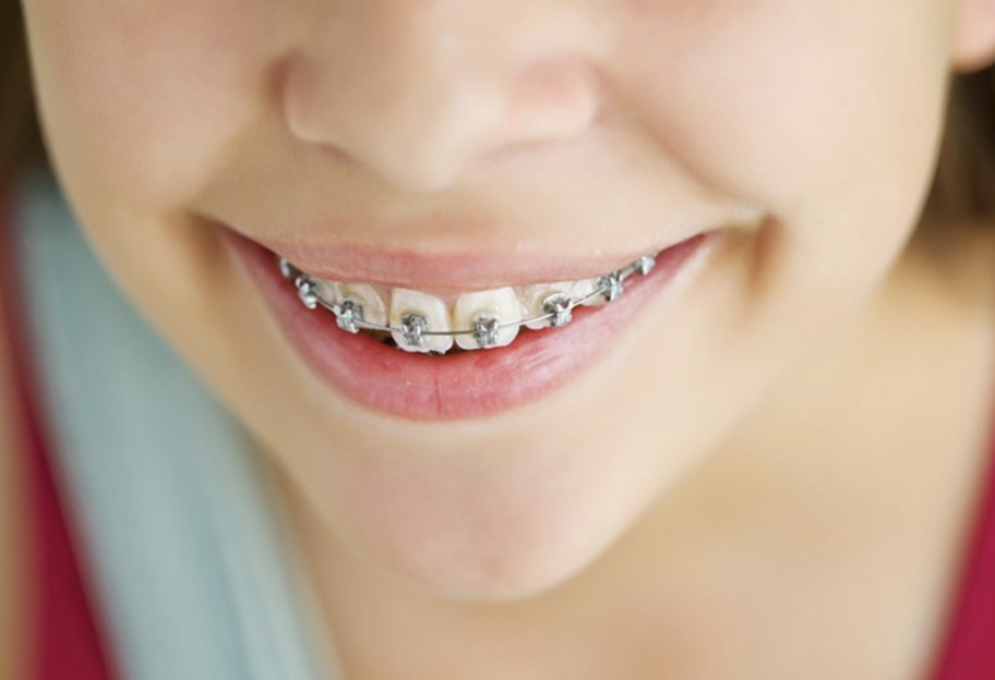 Топ-4 мифа о питании с брекетами и их опровержение - фото 1