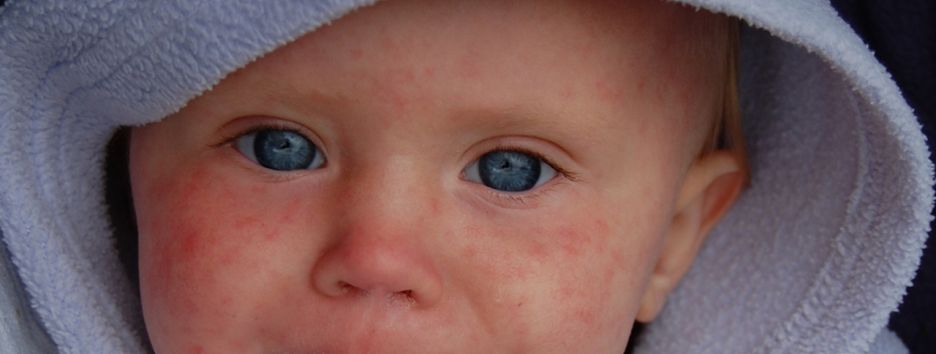 Корь в Украине: что происходит и как уберечься от инфекции