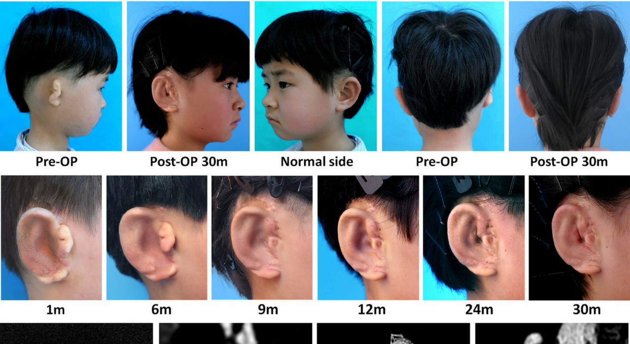 Детям в Китае вырастили новые уши из их собственных клеток