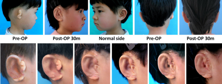 Детям в Китае вырастили новые уши из их собственных клеток