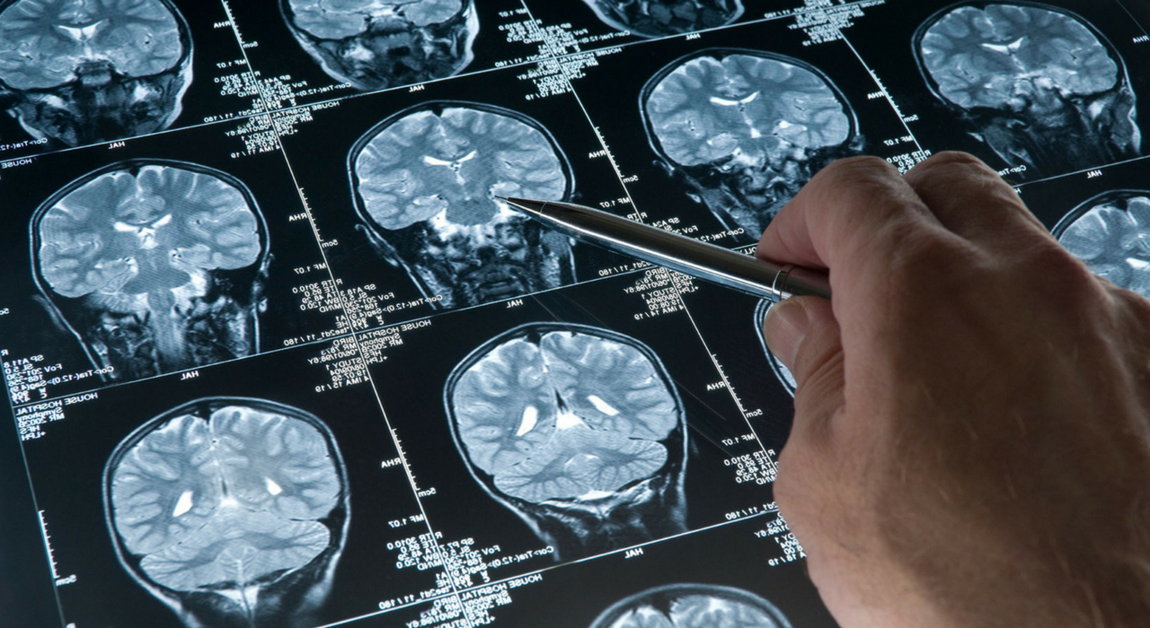 Высокий риск слабоумия сохраняется даже через 30 лет после черепно-мозговой травмы