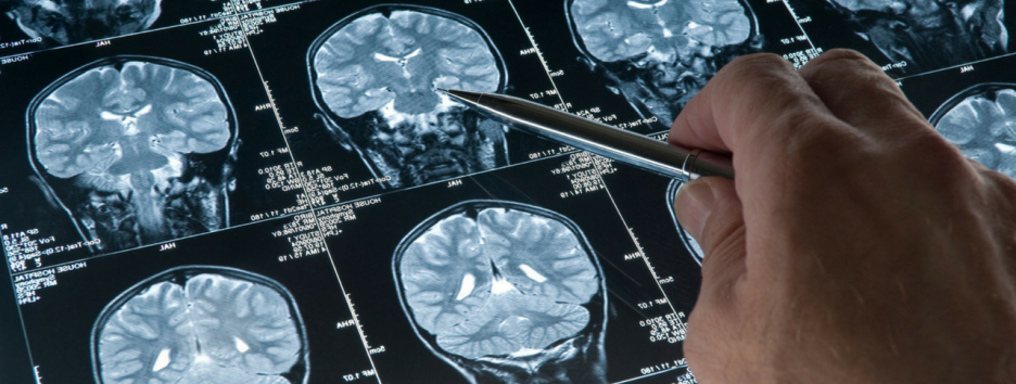 Высокий риск слабоумия сохраняется даже через 30 лет после черепно-мозговой травмы