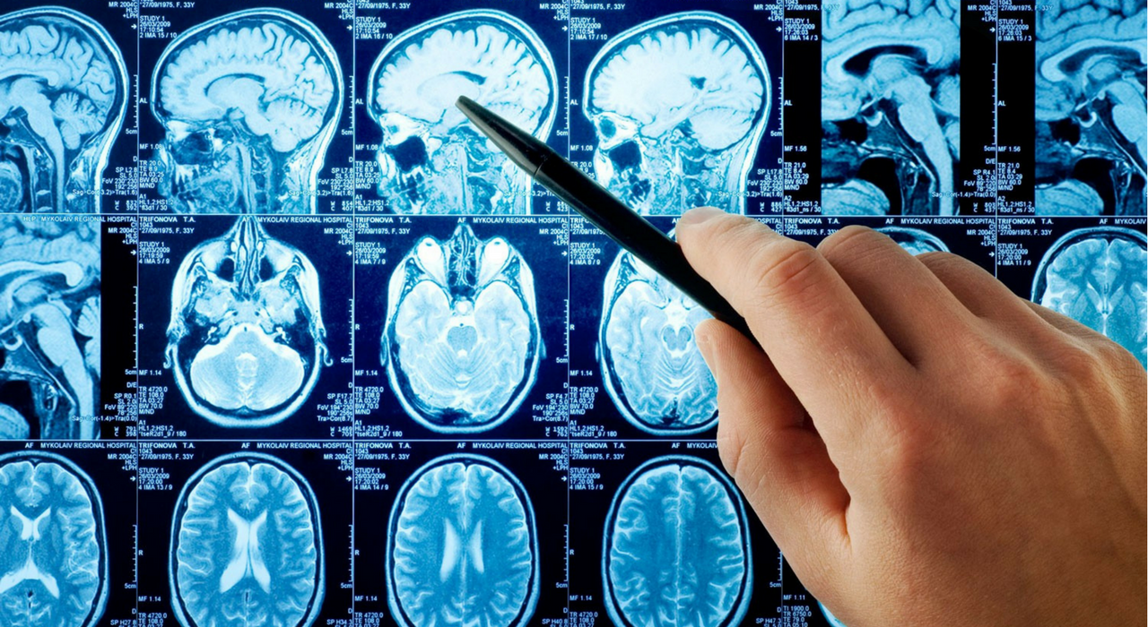 Время - это мозг: сосудистый хирург рассказал о причинах, лечении и профилактике инсульта