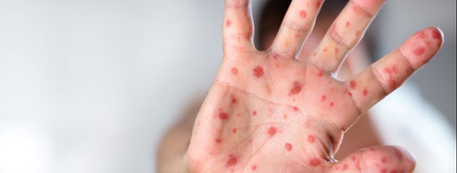 Корь в Украине: зоны риска для заболевания