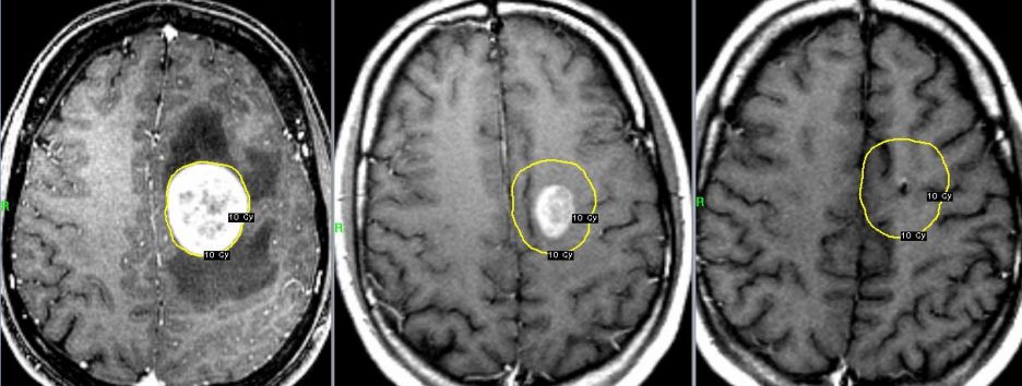 Ученые запрограммировали стволовые клетки уничтожать опухоль мозга