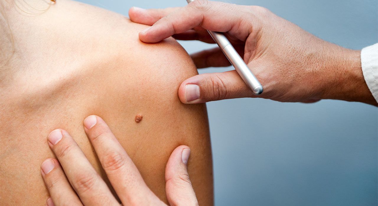 Искусственный интеллект распознает рак кожи не хуже онколога