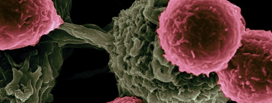 Предотвратить смертельную стадию: ученые сделали важное открытие о метастазах рака