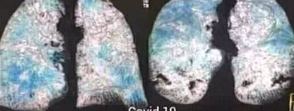 Покрываются «матовым стеклом»: медики показали легкие зараженных коронавирусом - фото