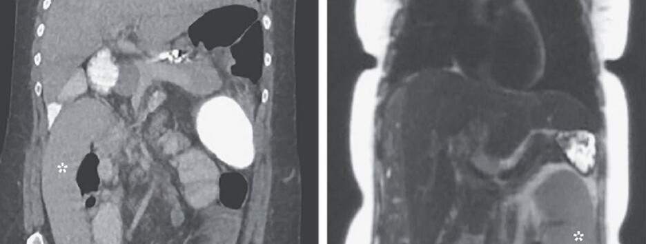 Блуждающий орган: медики рассказали о редком заболевании